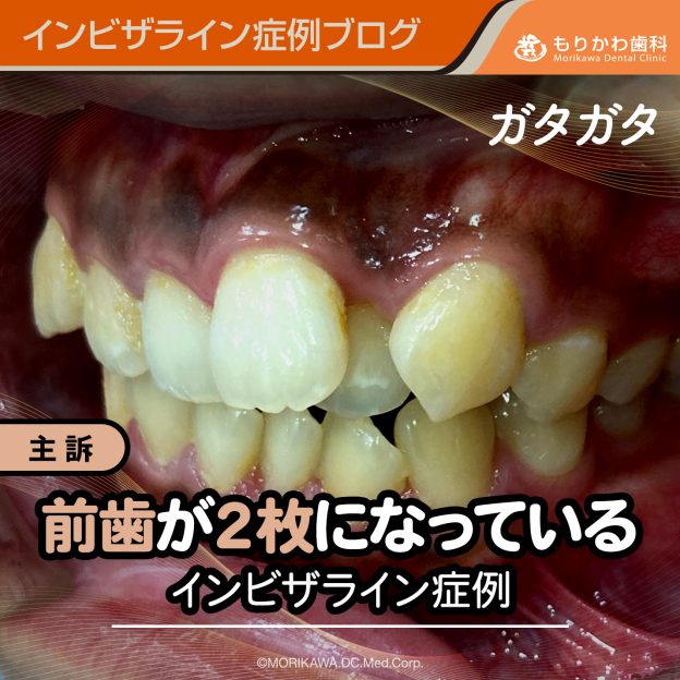 前歯が２枚になっているインビザライン症例