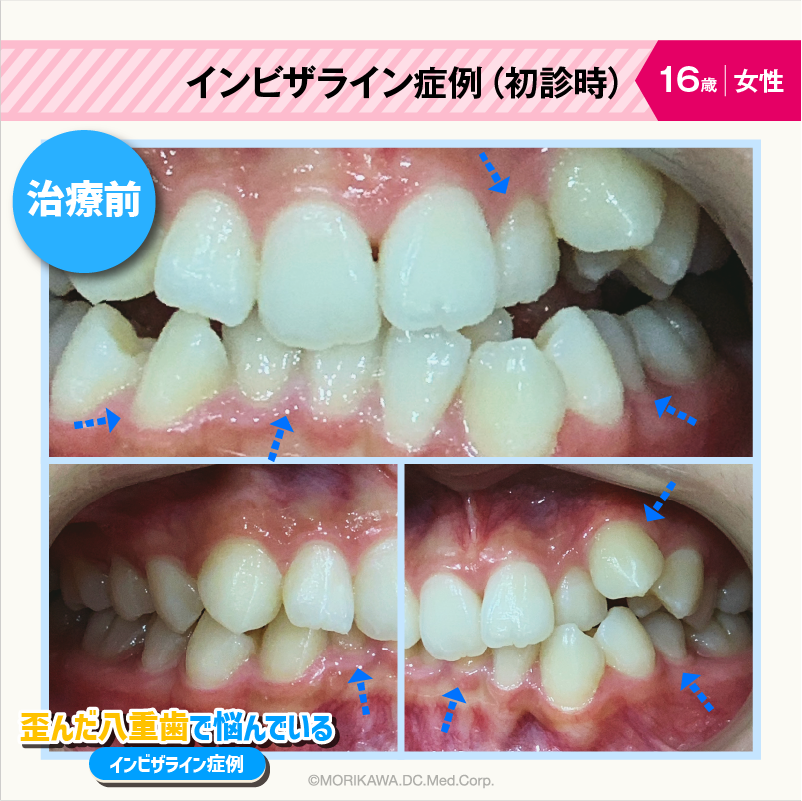 インビザライン症例（初診時）