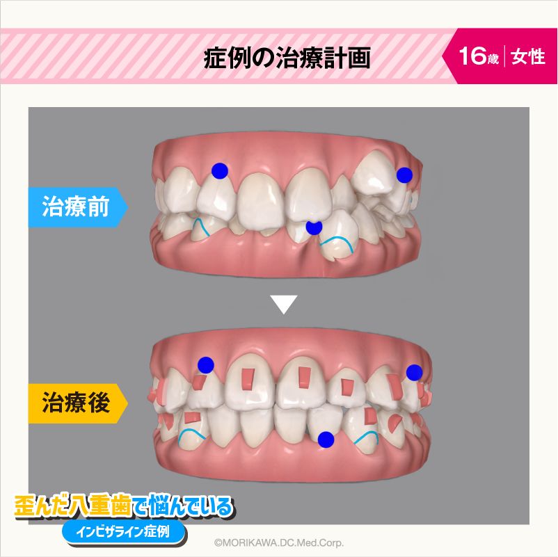 症例の治療計画