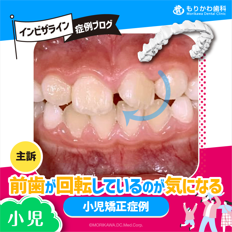 小児】主訴：「前歯が回転してるのが気になる」小児矯正症例 - 八尾市