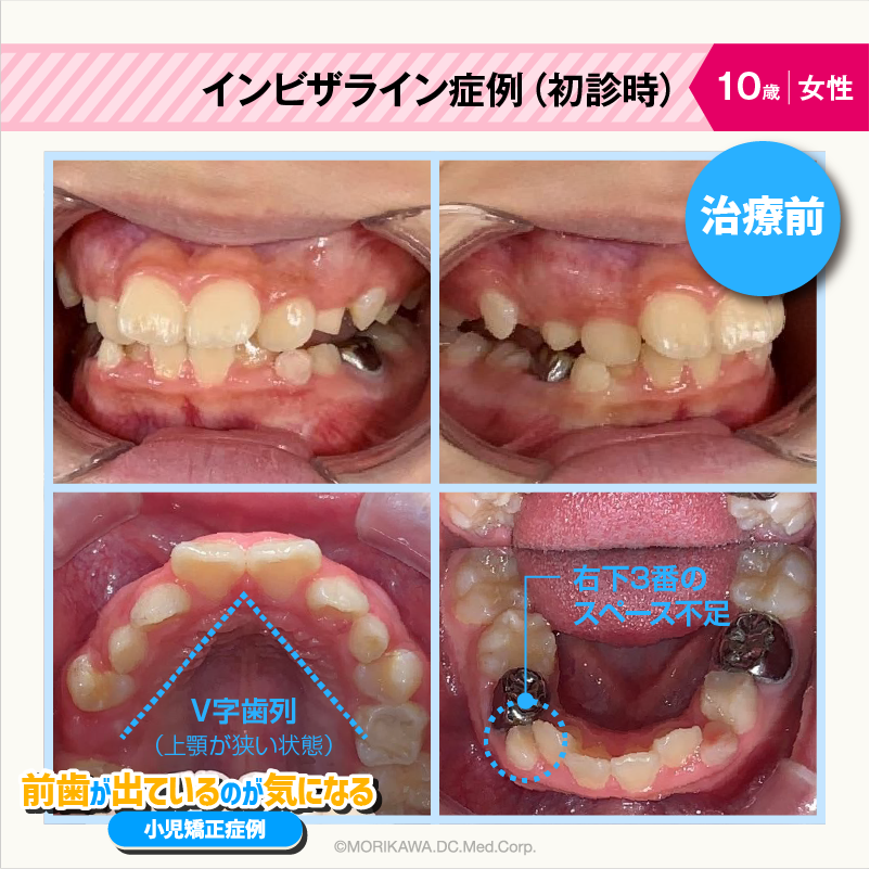 インビザライン症例（初診時）