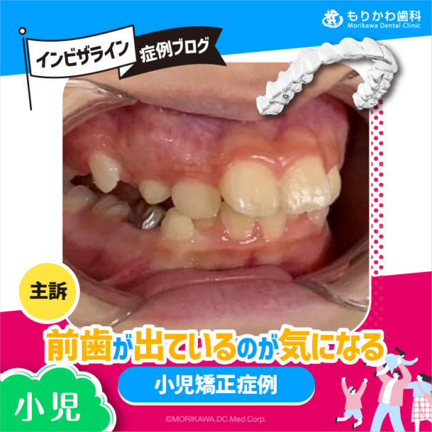 前歯が出ているのが気になる小児矯正症例