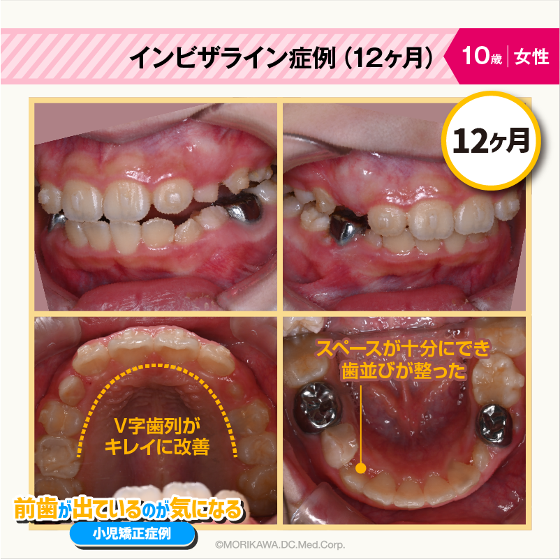 インビザライン症例（12ヶ月）