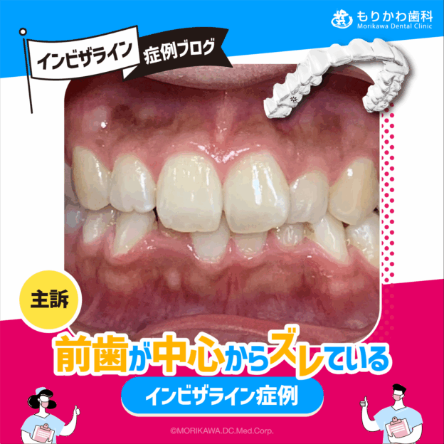 前歯が中心からズレている