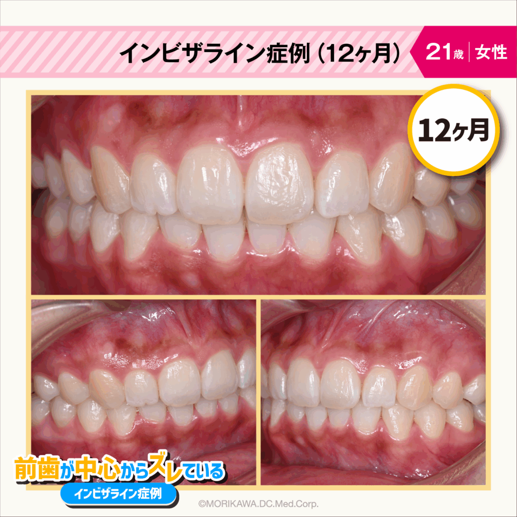 インビザライン症例（12ヶ月）