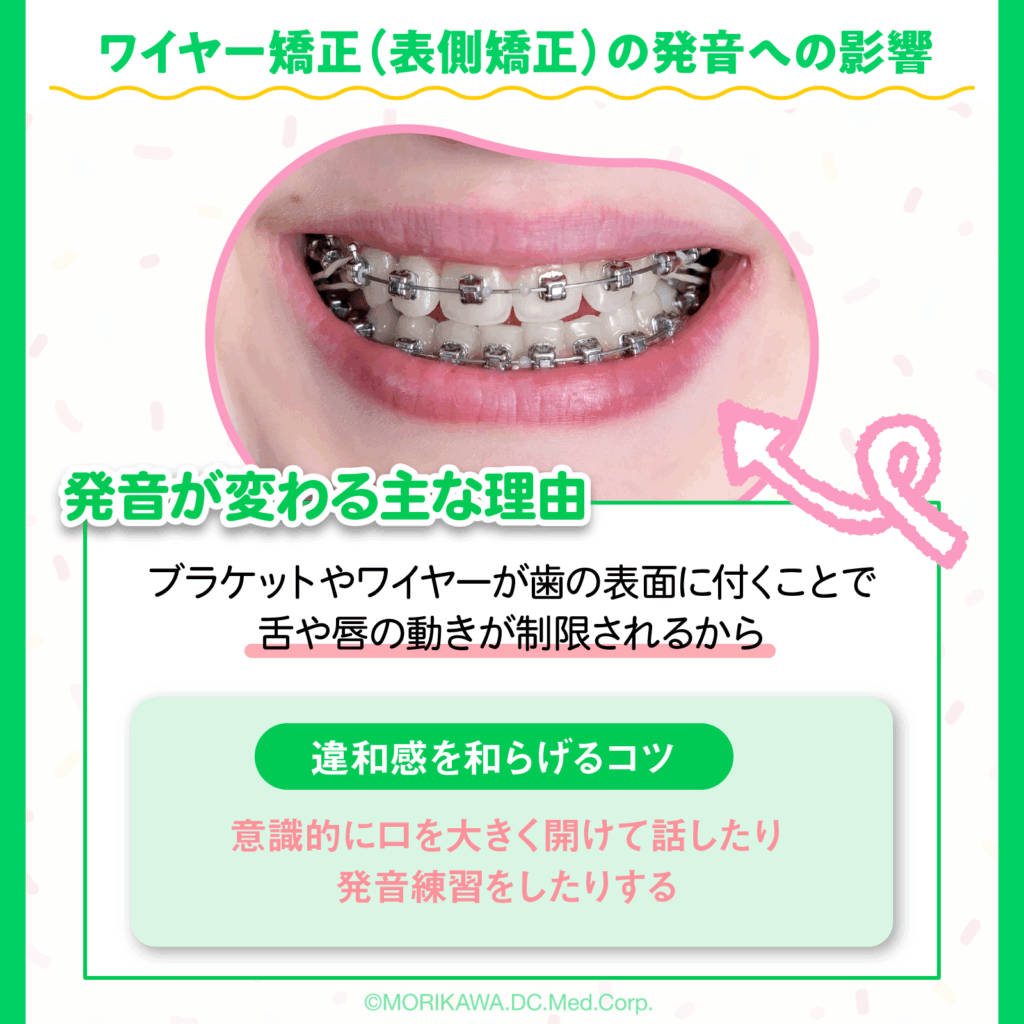 ワイヤー矯正（表側矯正）の発音への影響