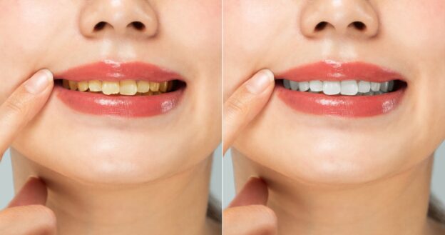 黄ばんだ歯とホワイトニングした歯