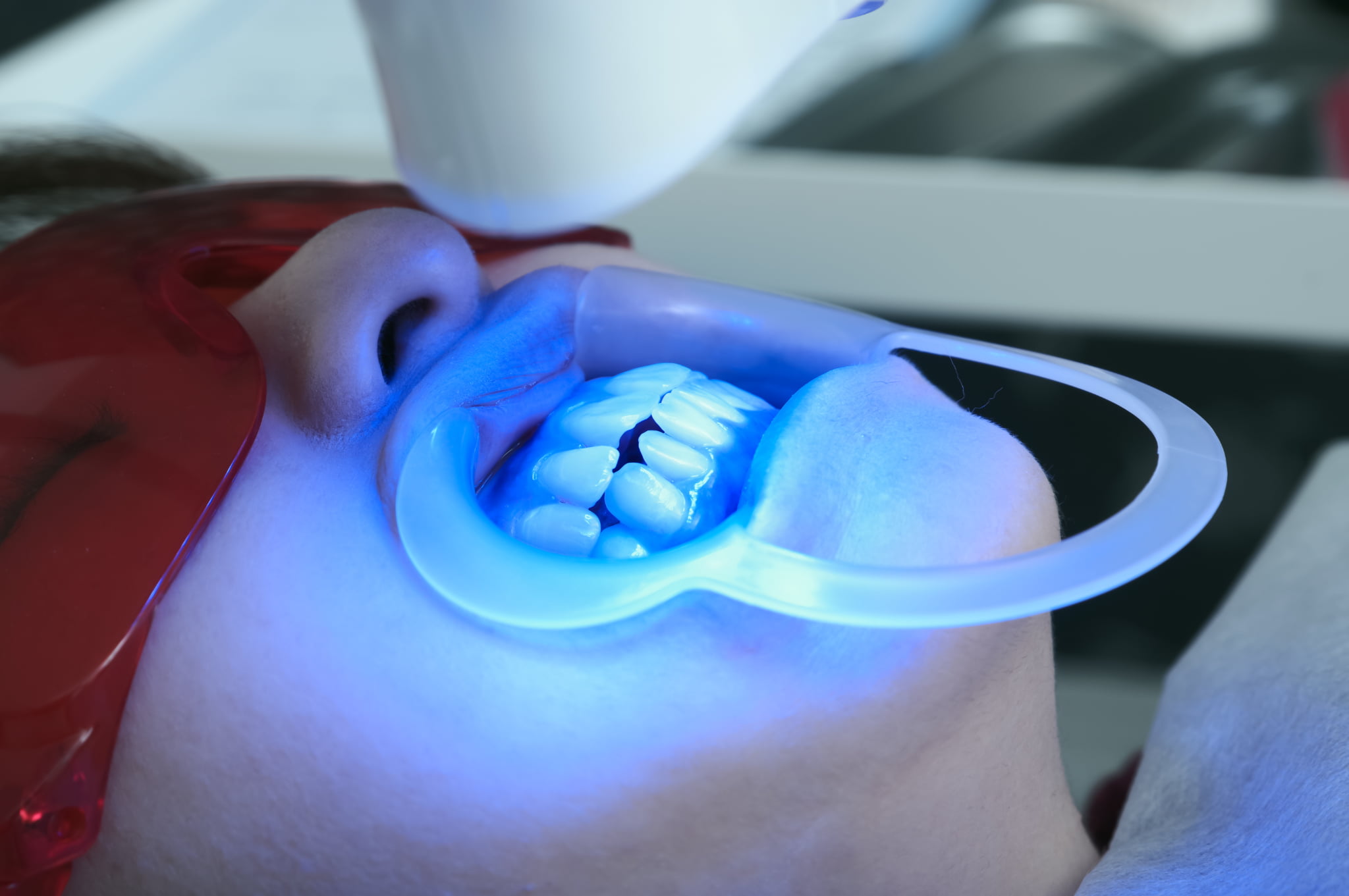 オフィスホワイトニングのイメージ