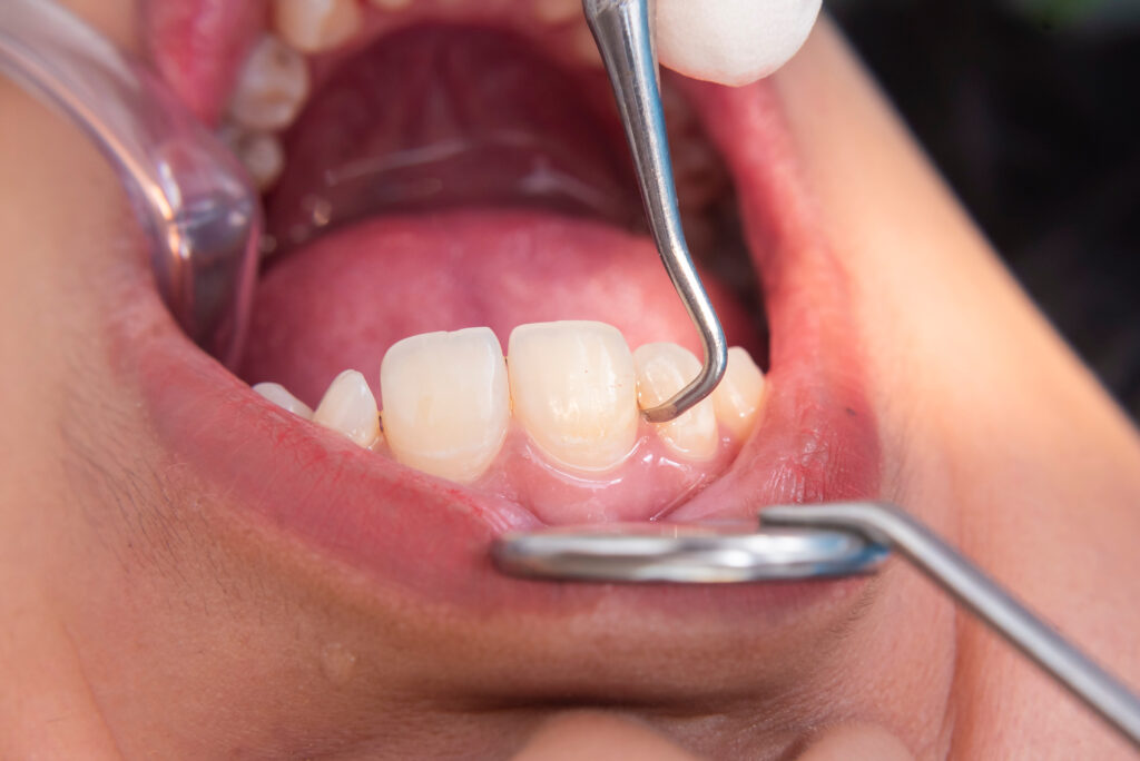 歯科医師が患者の口を開いて歯石取り治療をしている