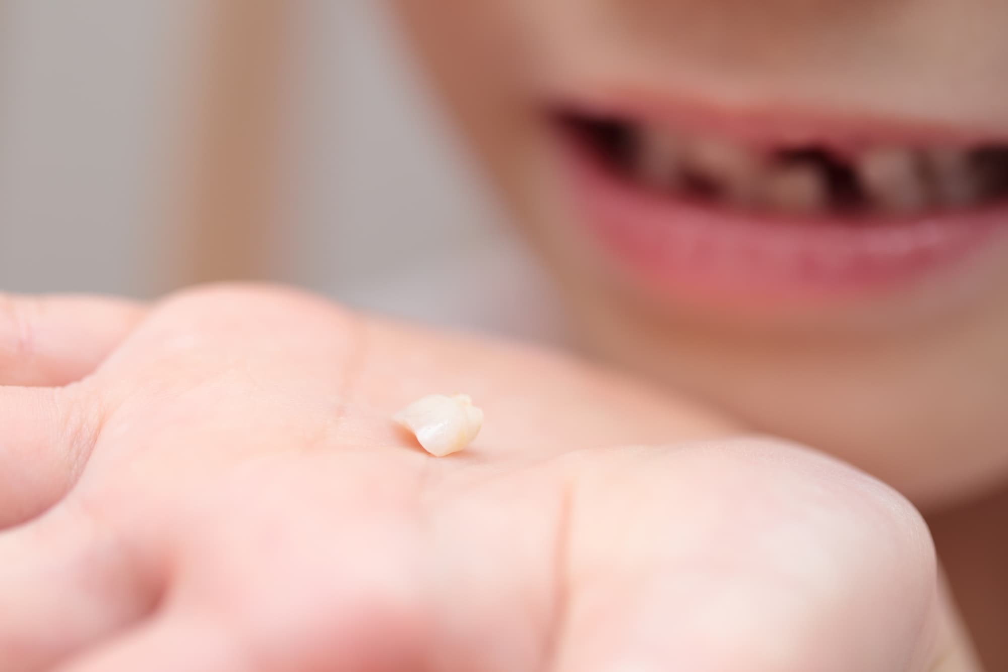 出っ歯を放置して欠けた歯