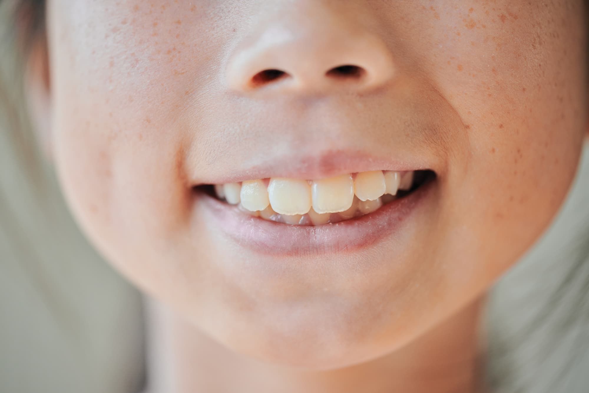 出っ歯の女の子の口元