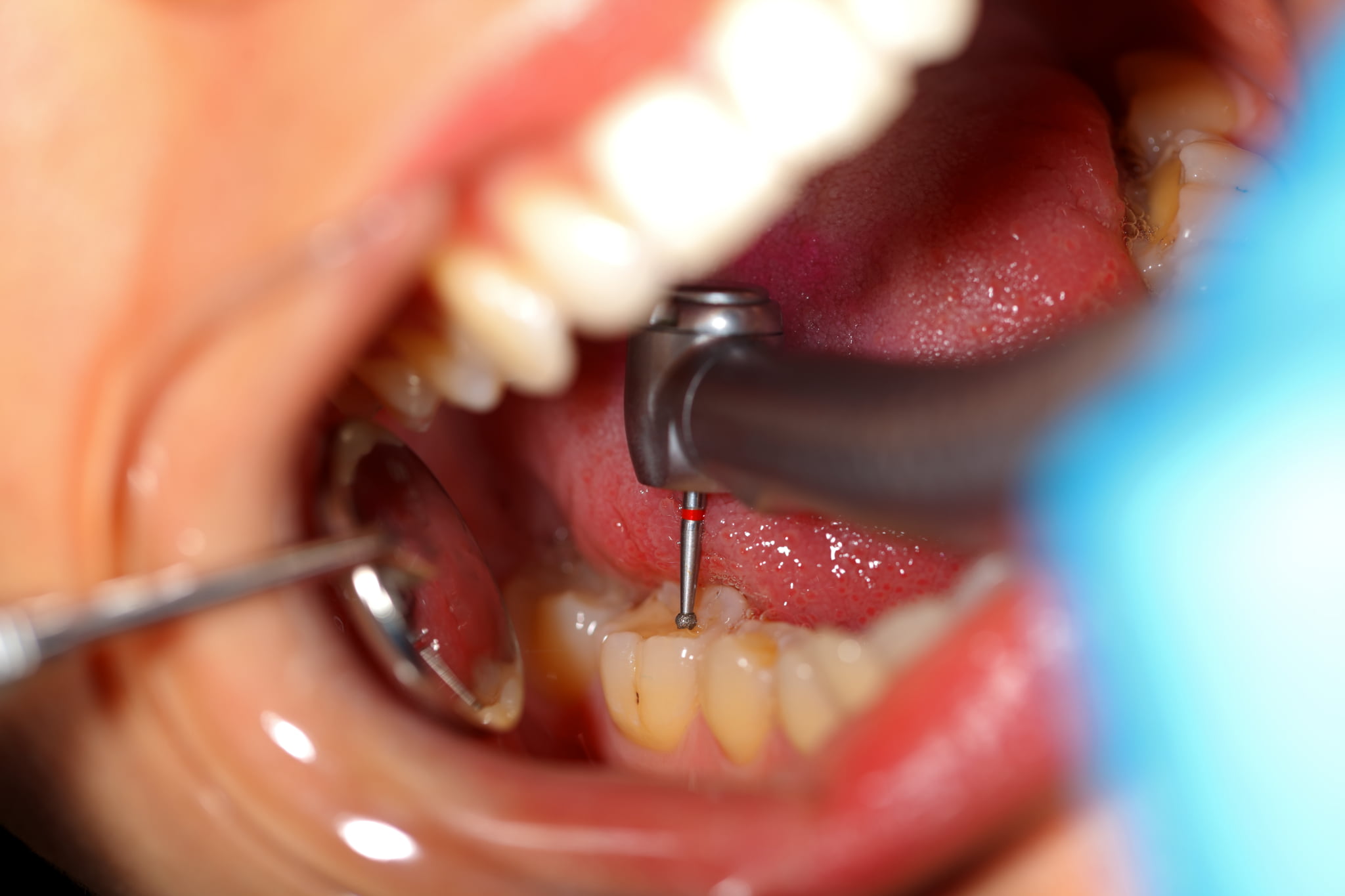 奥歯の虫歯を治療しているイメージ