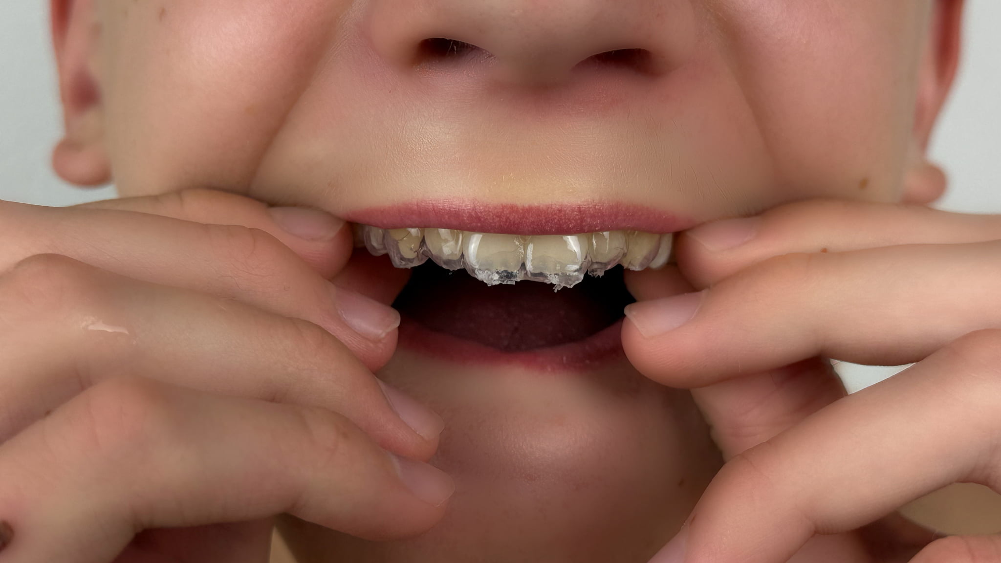 インビザライン・ファーストのマウスピースを装着しようとしている子どもの口元